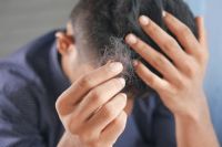 Hair loss  hair,hand,alopecia